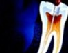 endodoncia-1b_big