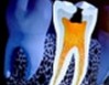 endodoncia-3b_big