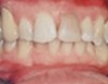 implantes-3b_big