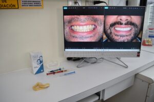 Blanqueamiento Dental Profesional