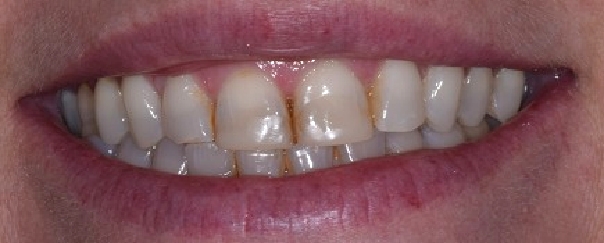 antes_despues001_a antes_despues001_a