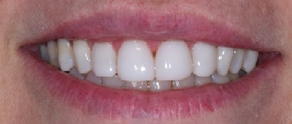 antes_despues001_b antes_despues001_b