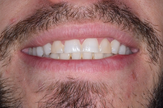 antes_despues006_a antes_despues006_a